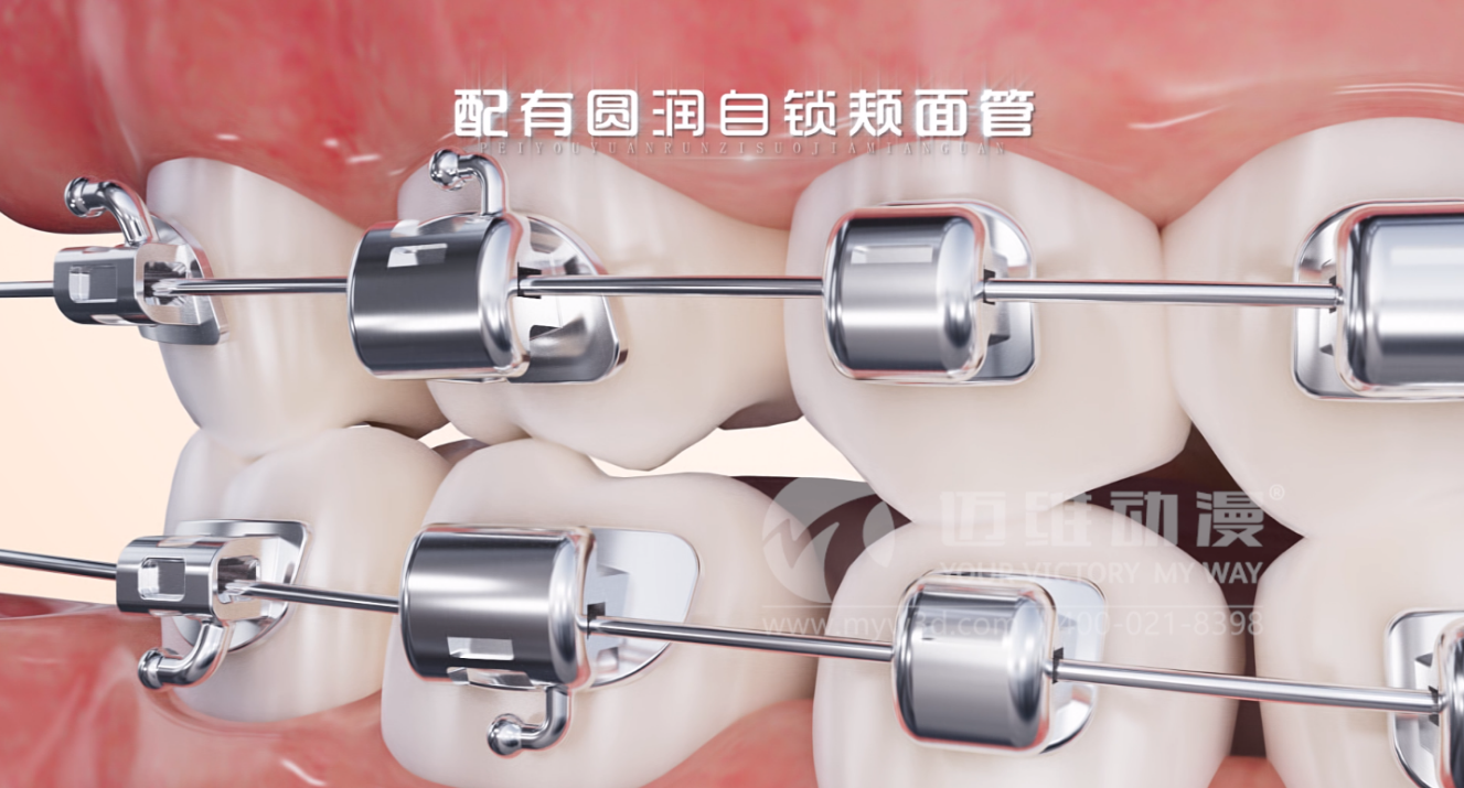 華文7D自鎖托槽產品展示三維動畫(圖1) 華文7D自鎖托槽產品展示三維動畫(圖1)