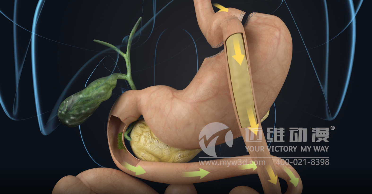 熱烈祝賀邁維動漫與杭州糖吉醫療科技有限公司圓滿完成胃轉流支架系統三維動畫項目合作！(圖2)