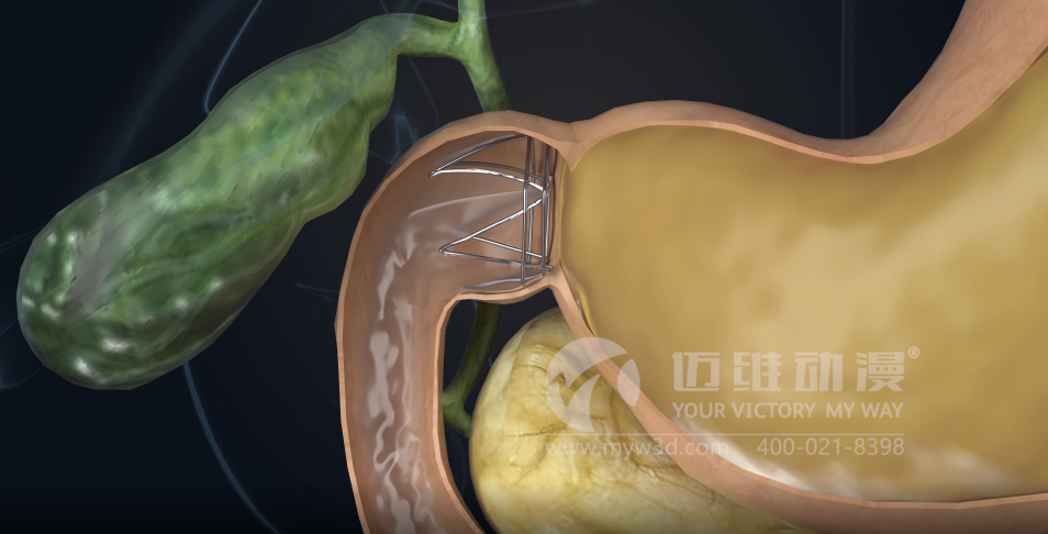 熱烈祝賀邁維動漫與杭州糖吉醫療科技有限公司圓滿完成胃轉流支架系統三維動畫項目合作！(圖3)