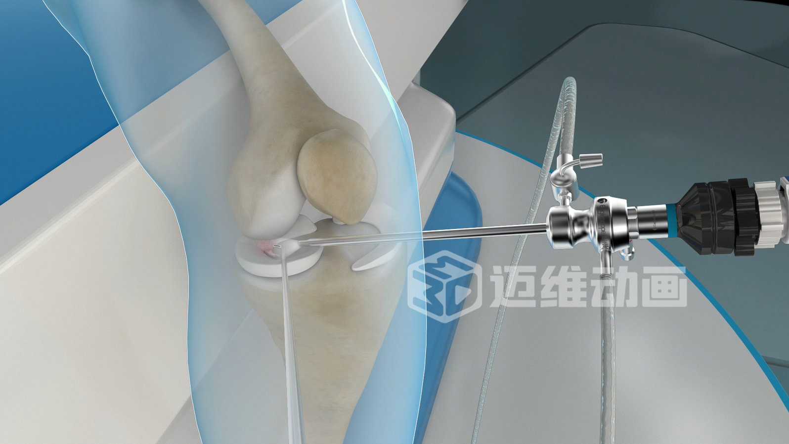 關(guān)節(jié)鏡手術(shù)三維動(dòng)畫(huà) 關(guān)節(jié)鏡手術(shù)三維動(dòng)畫(huà)