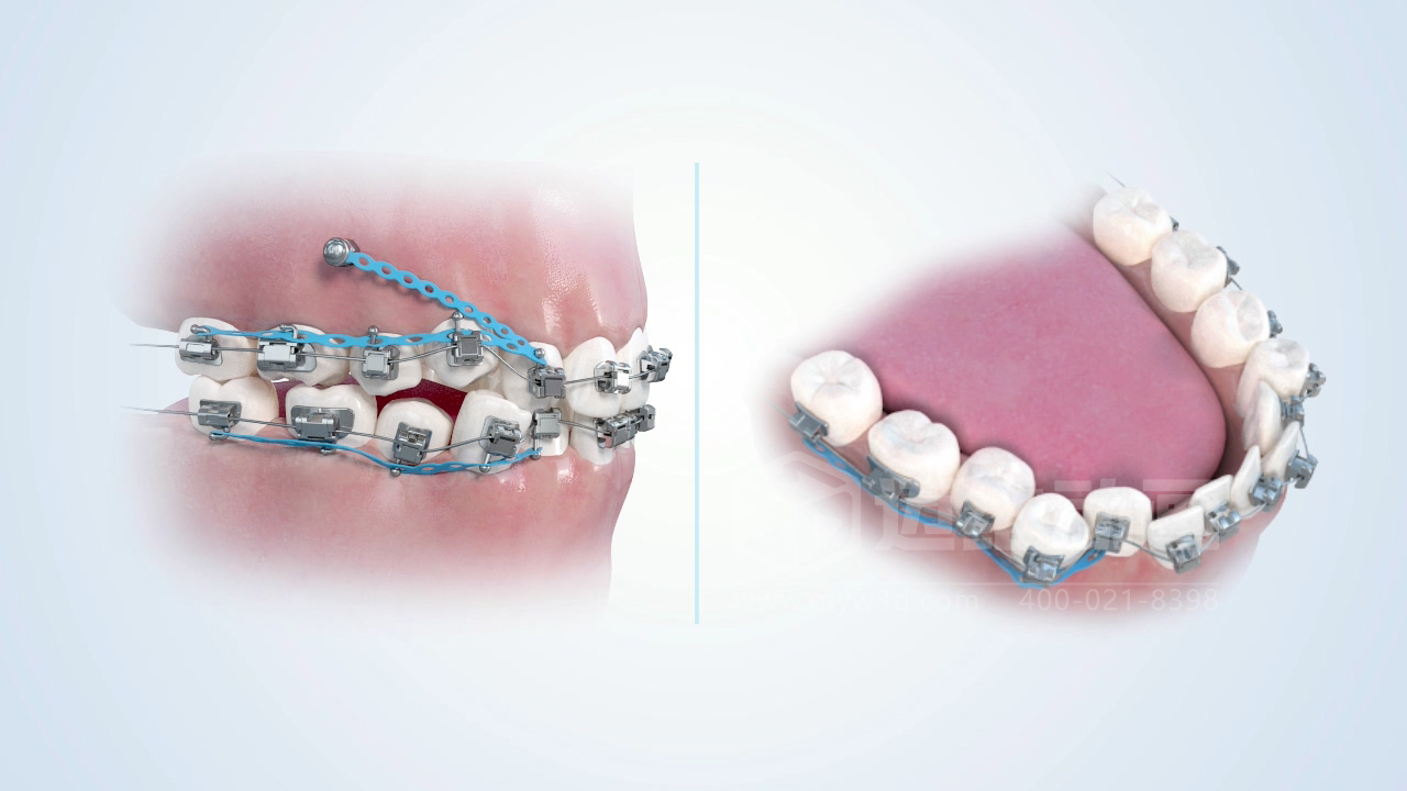 從實驗室到手術室:邁維動漫用三維動畫,讓精密科技“看得見,懂得到”訂單轉化率提高 50%(圖10) 從實驗室到手術室:邁維動漫用三維動畫,讓精密科技“看得見,懂得到”訂單轉化率提高 50%(圖10)